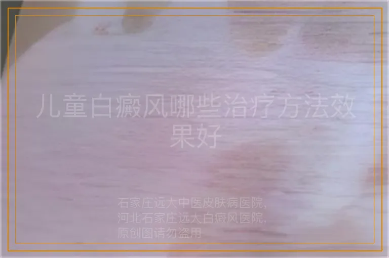 儿童白癜风哪些治疗方法效果好