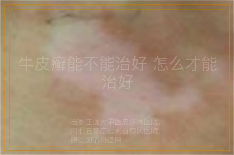 牛皮癣能不能治好 怎么才能治好